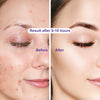 180pcs/set Face Skin Care Acne Pimple Patch